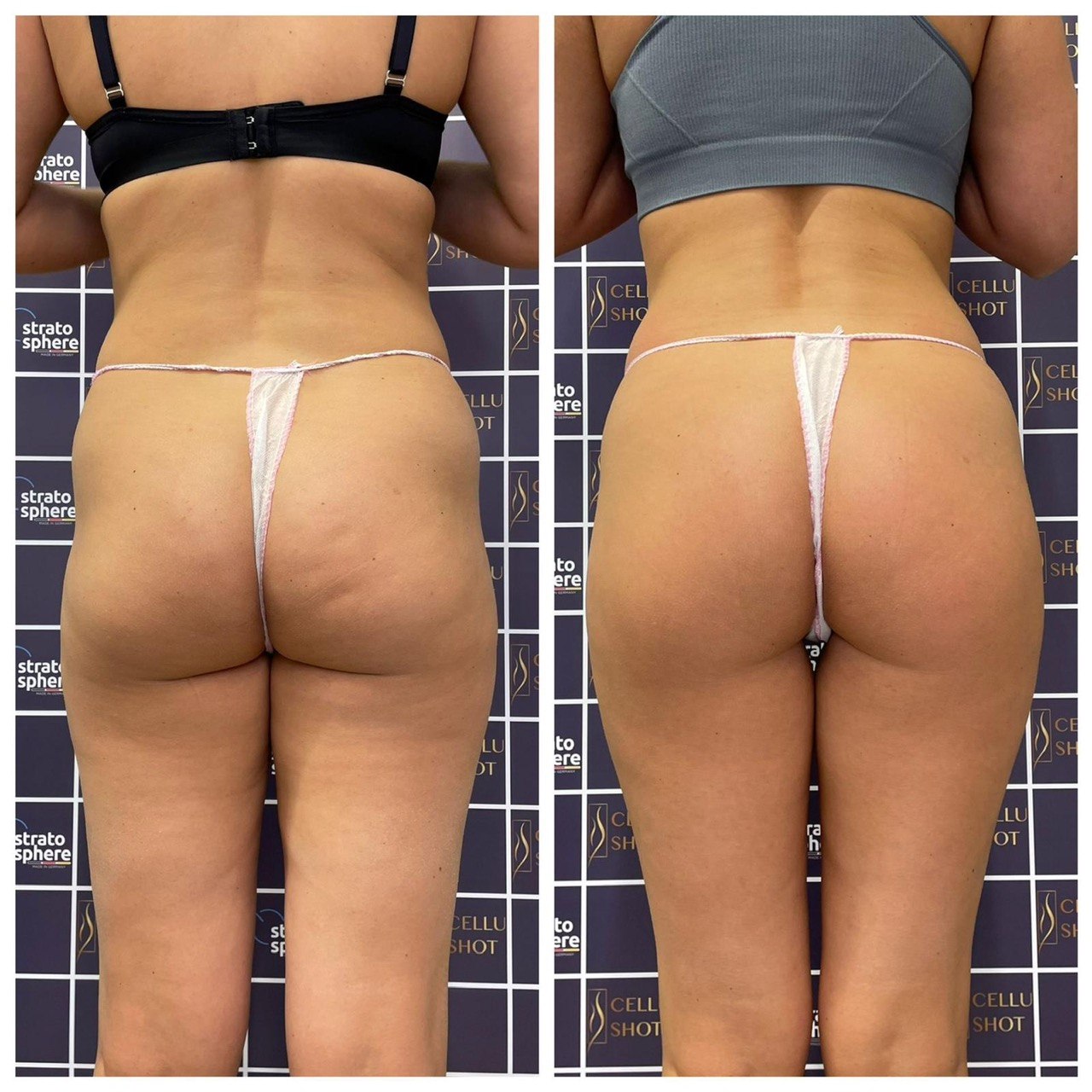 Stratosphere body contouring — ID Clinic Esbjerg