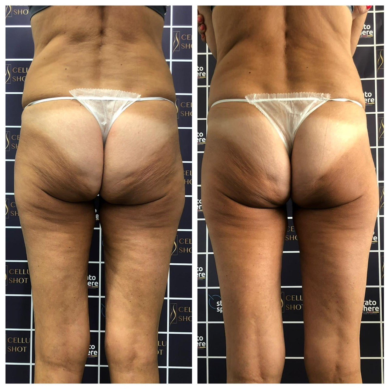 Stratosphere body contouring — ID Clinic Esbjerg